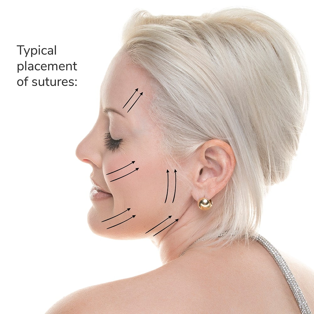 placement sutures placement sutures