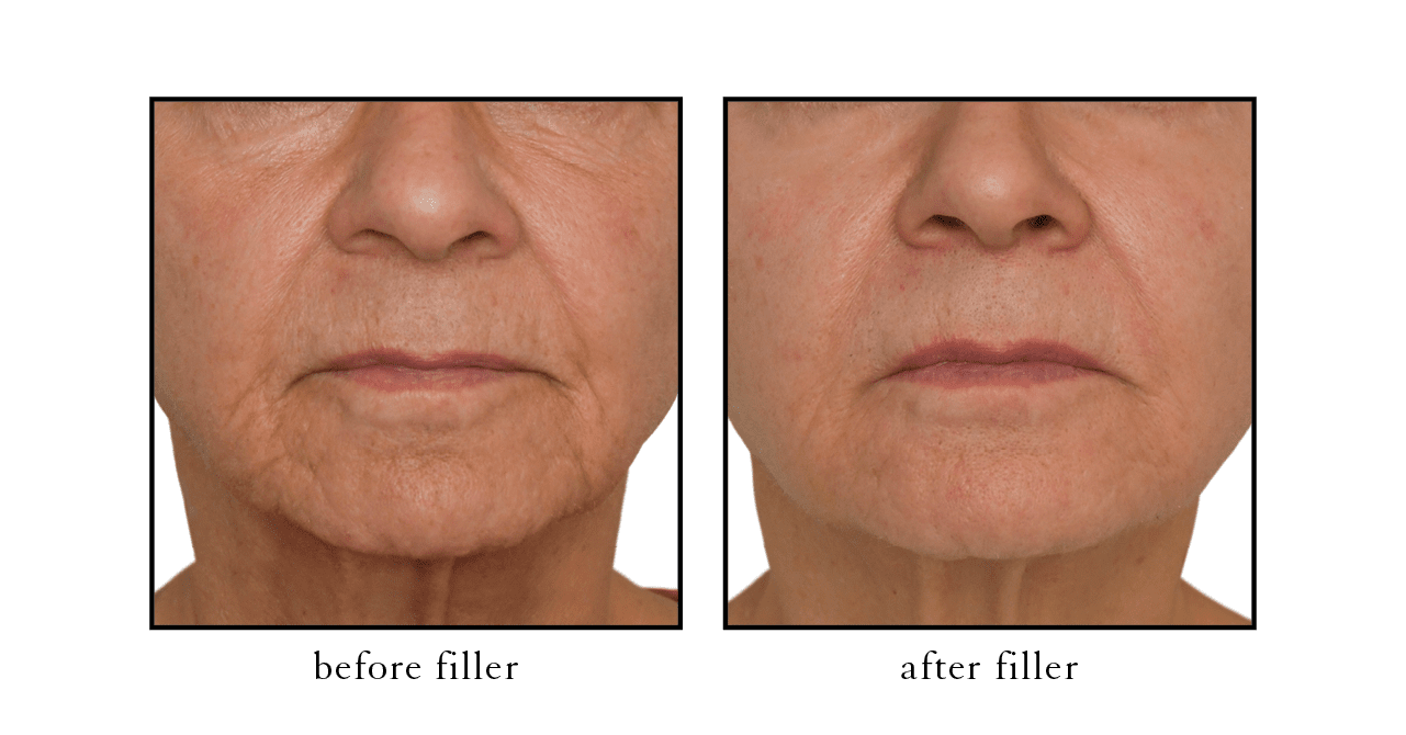 CSLC filler CSLC filler