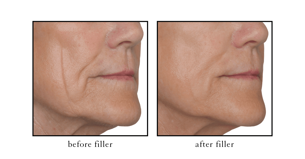 CSLC filler2 CSLC filler