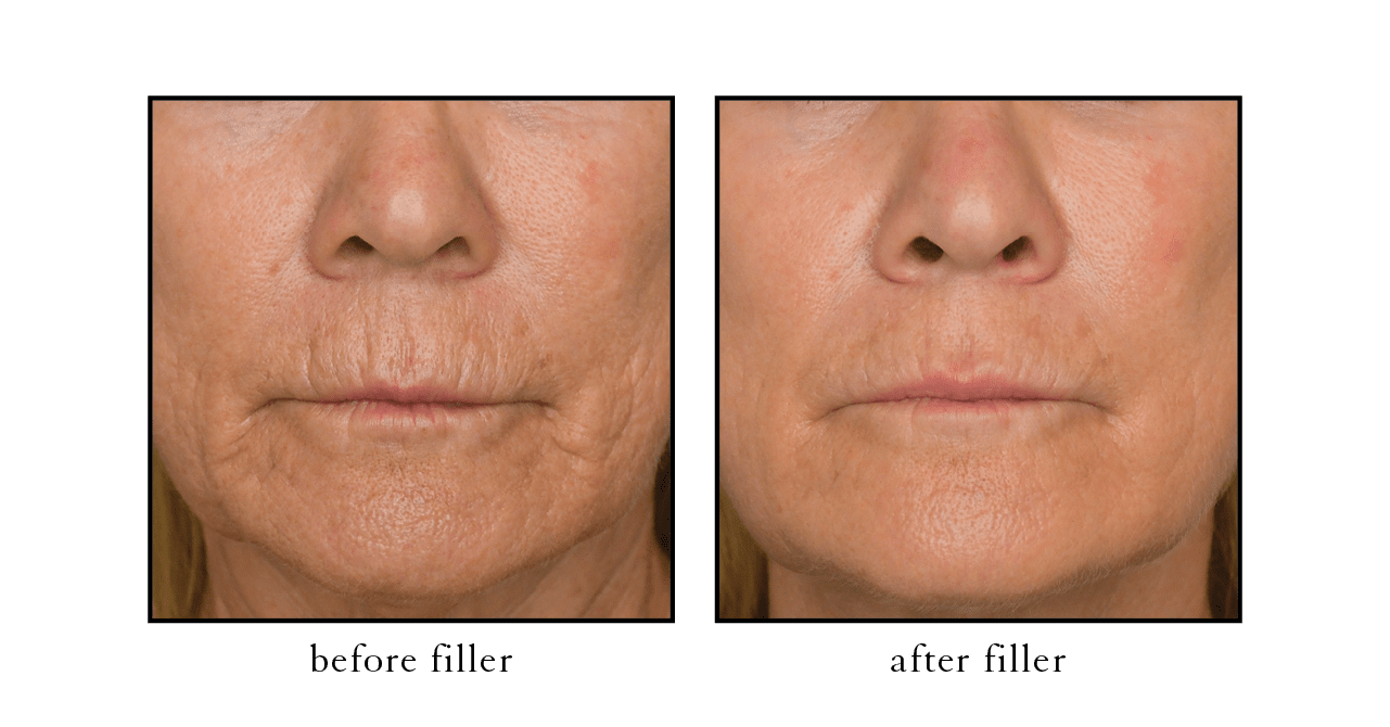 CSLC fillers CSLC filler