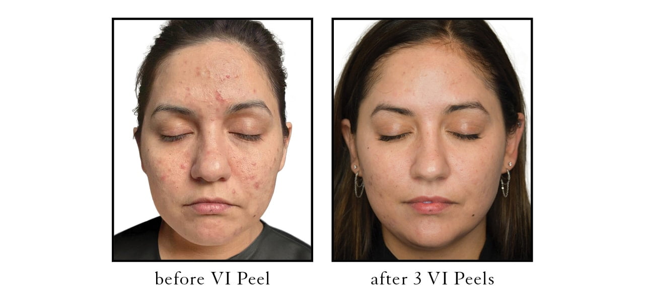 VI Peel before after VI Peel before after