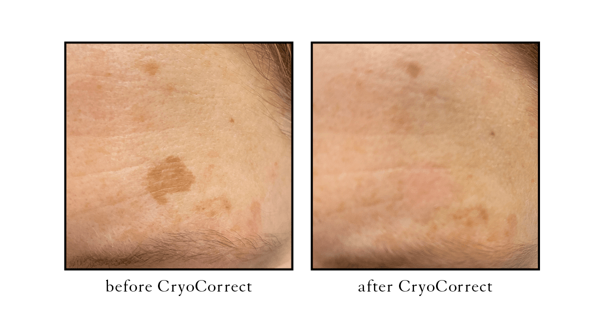 cryocorrect cryocorrect Cosmetic Skin & Laser Center
