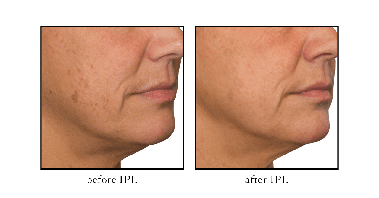 IPL3 IPL before after