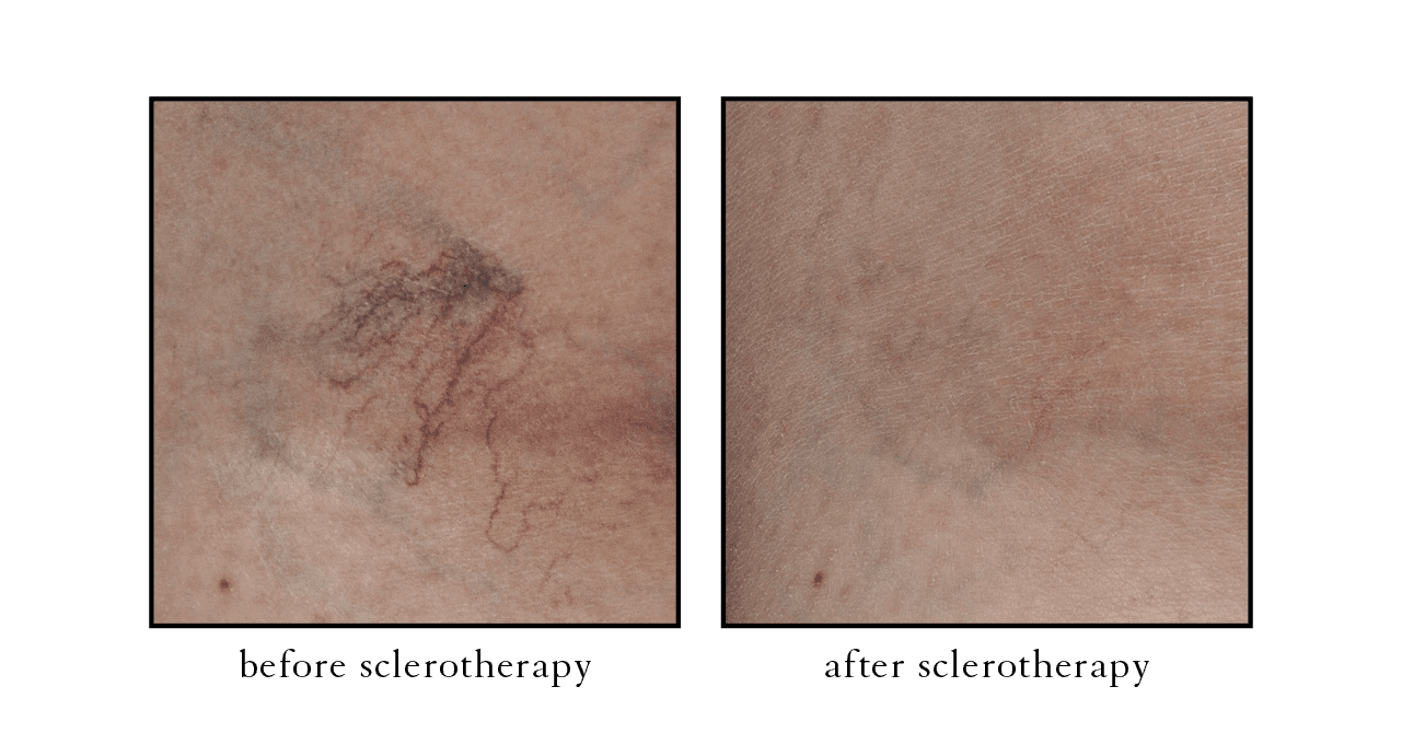 sclero sclerotherapy