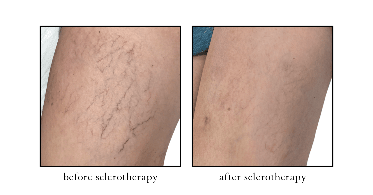 sclero2 sclerotherapy