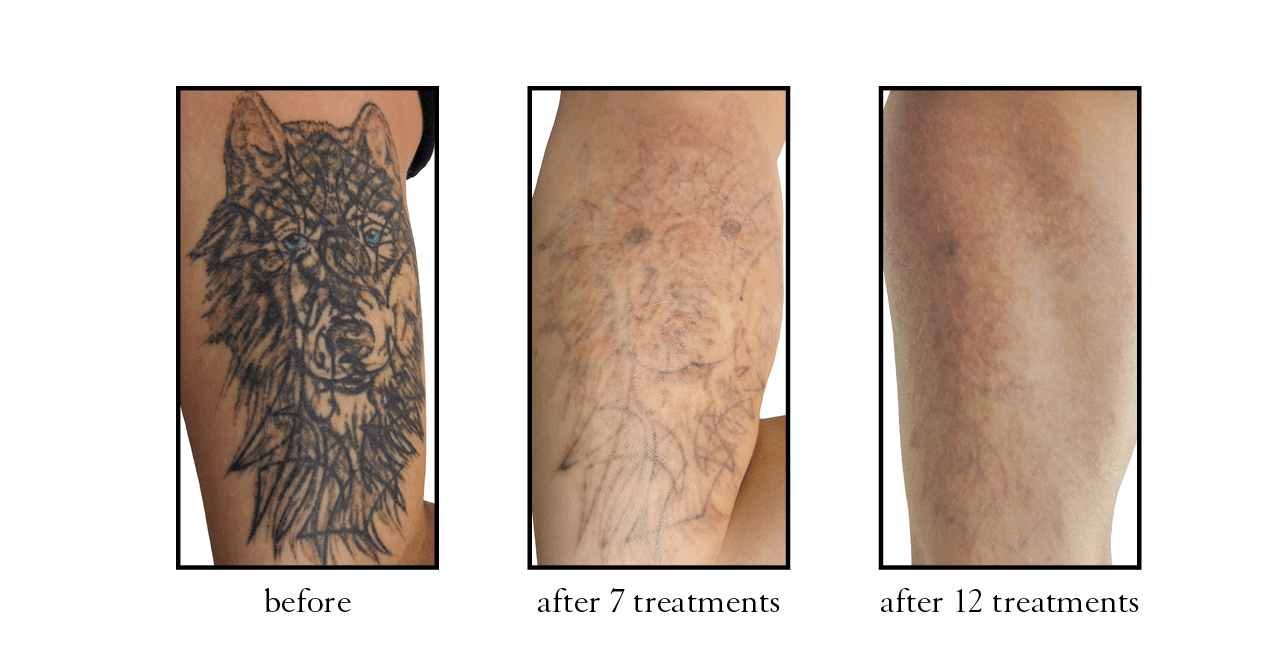 tattoo removal