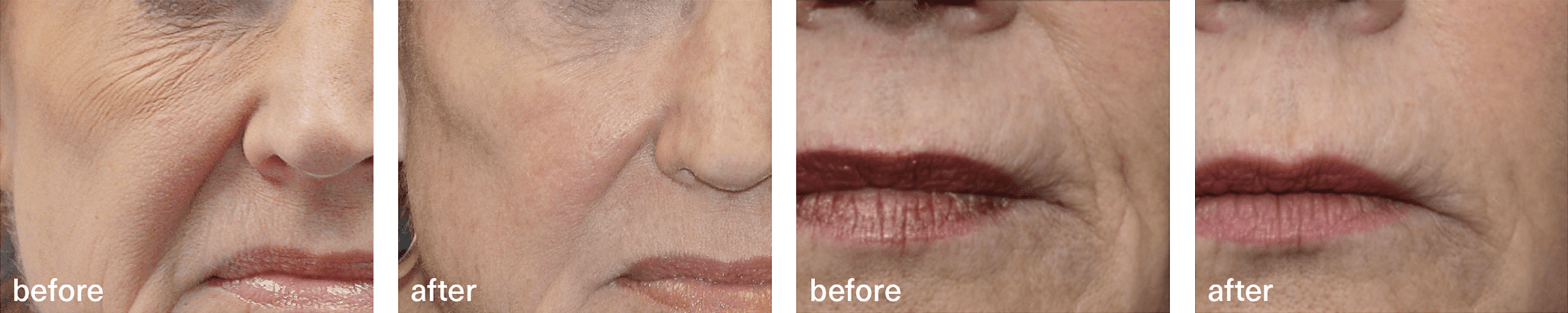 thermismooth before after