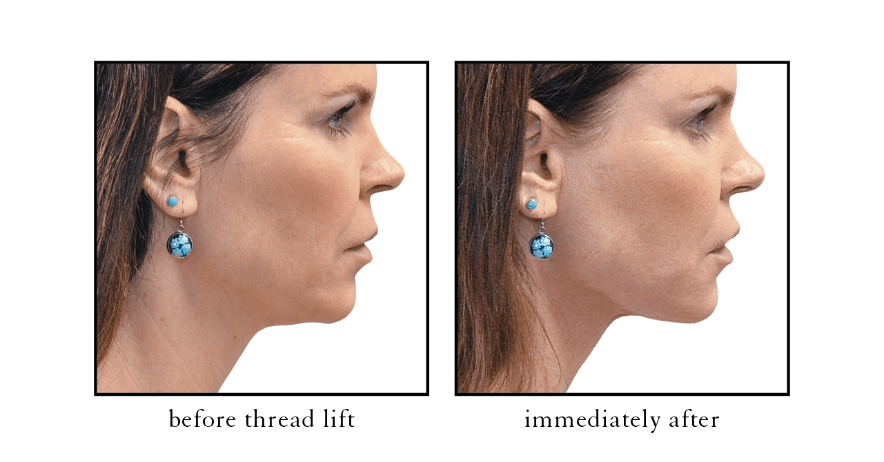 thread lift1 thread lift