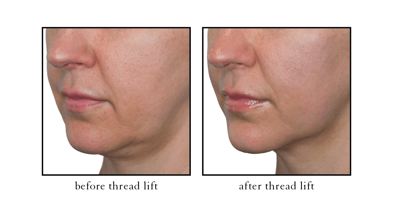 thread lift3 thread lift