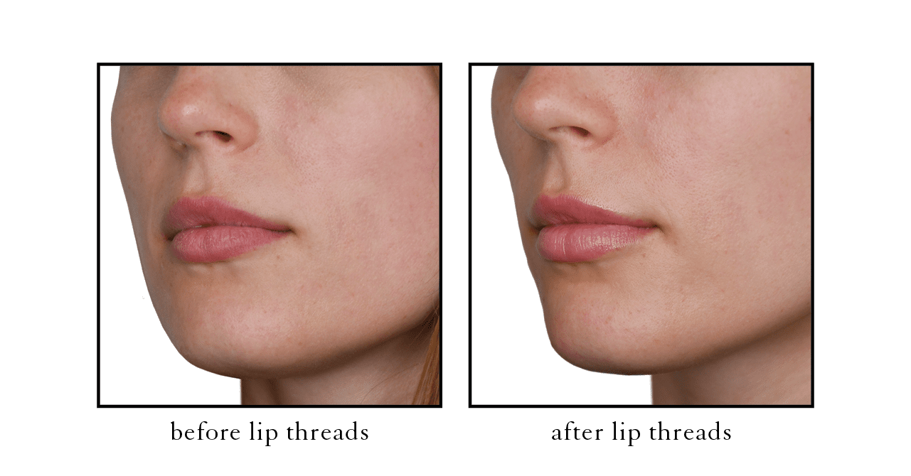 thread lift4 thread lift