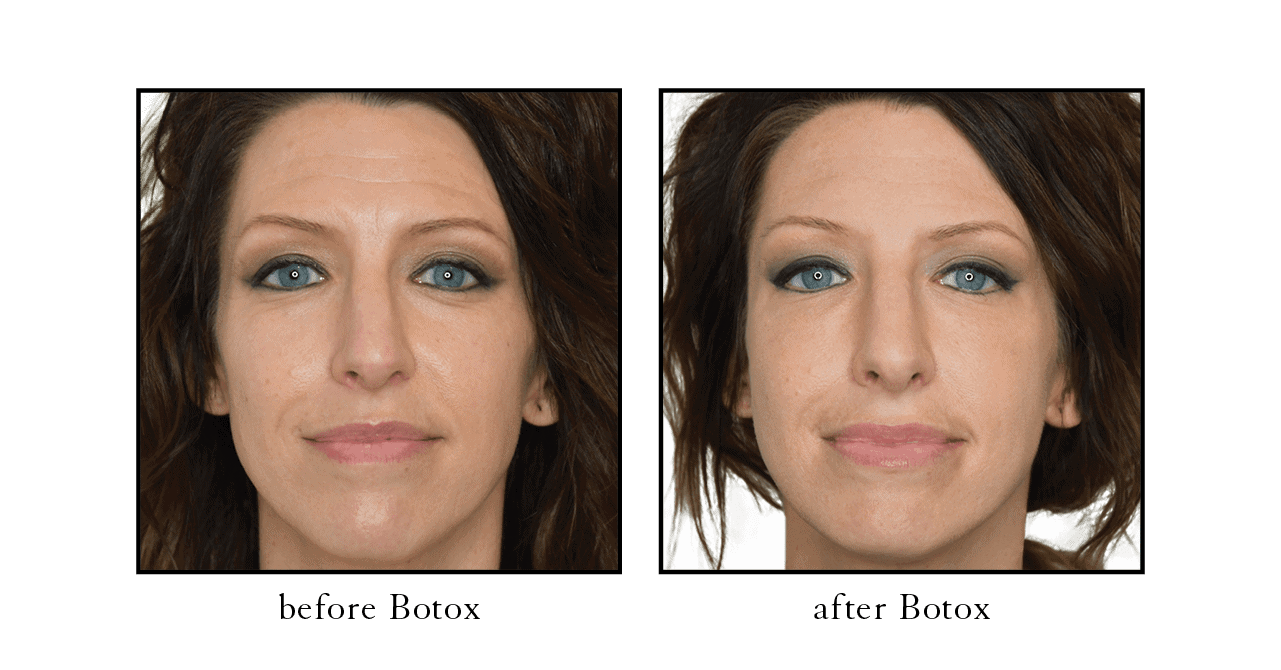 botox before after