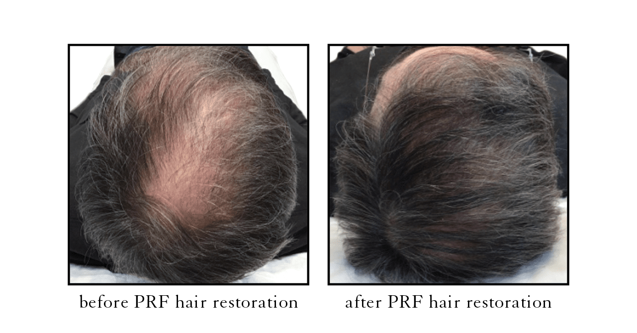 PRF hair restoration