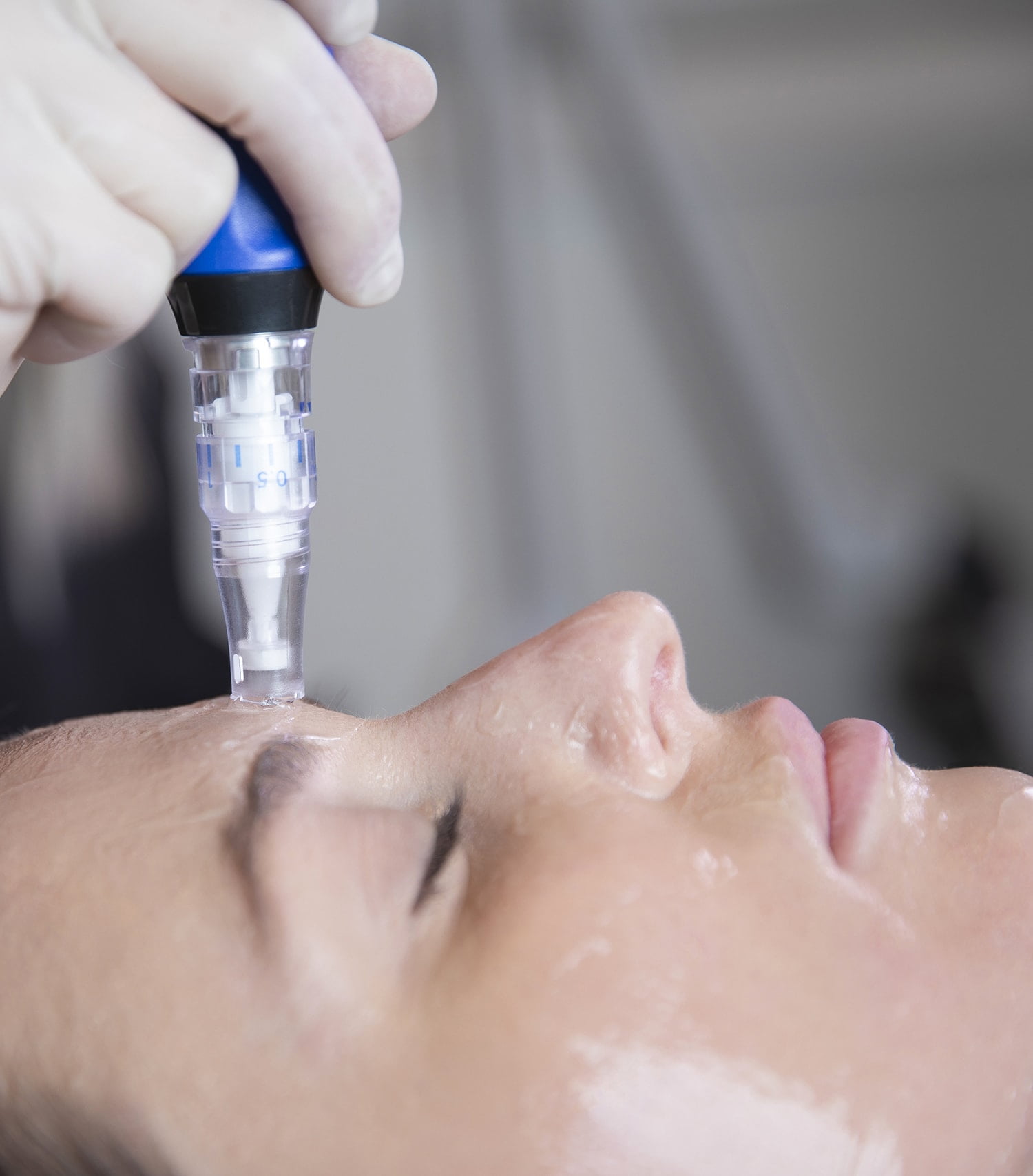 microneedling cslc