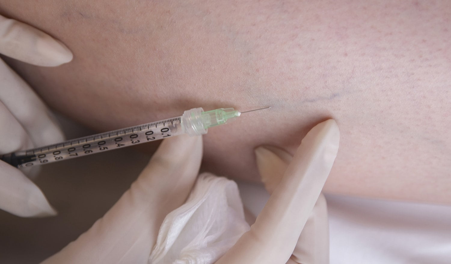 sclerotherapy sclerotherapy