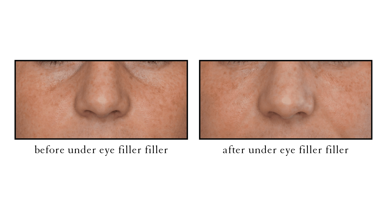 under eye filler under eye filler