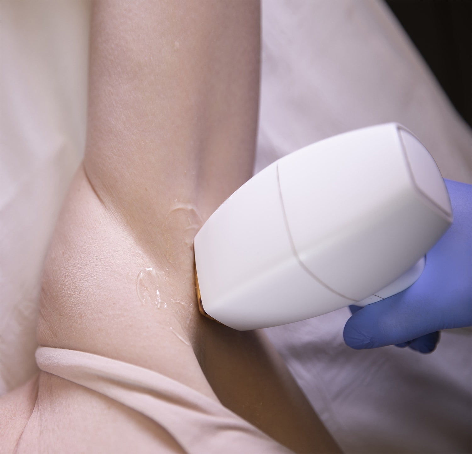 laser hair removal underarm