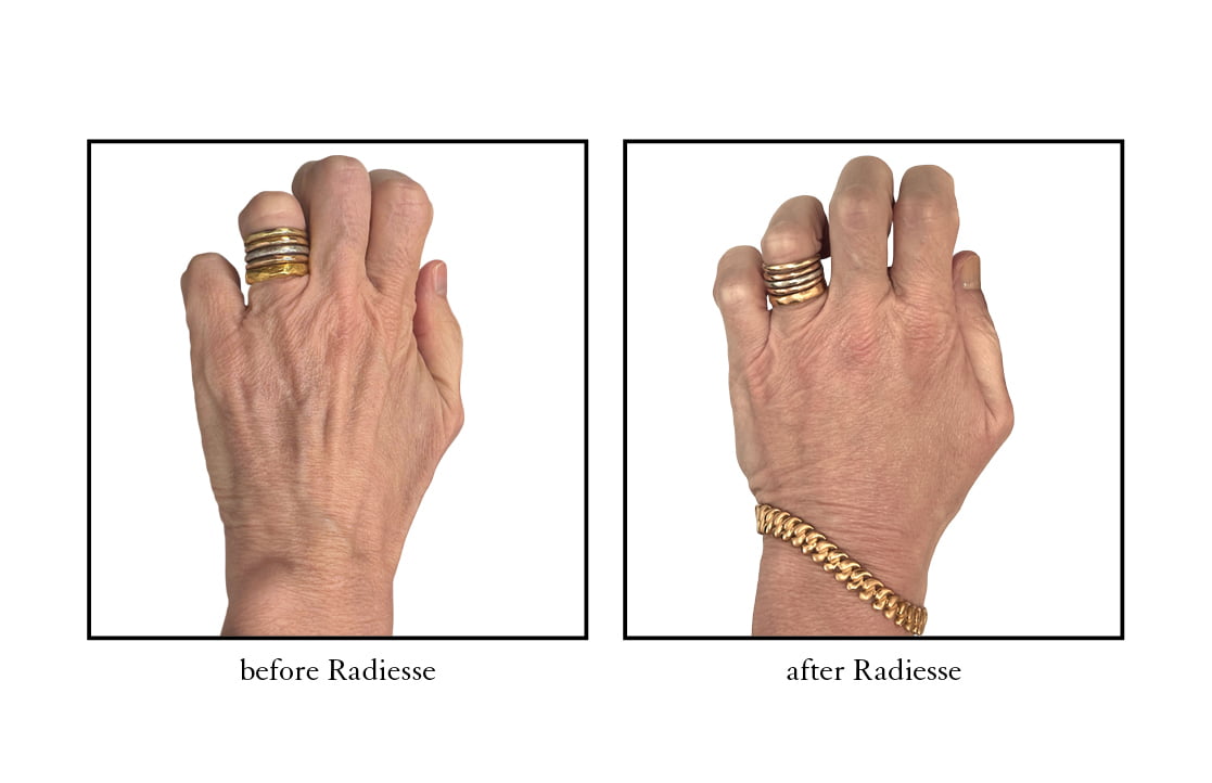 Radiesse Before and After Radiesse Before and After