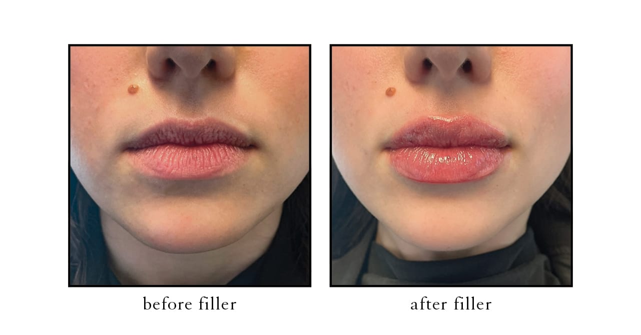 lip filler anna before after cslc Lip filler before and after results