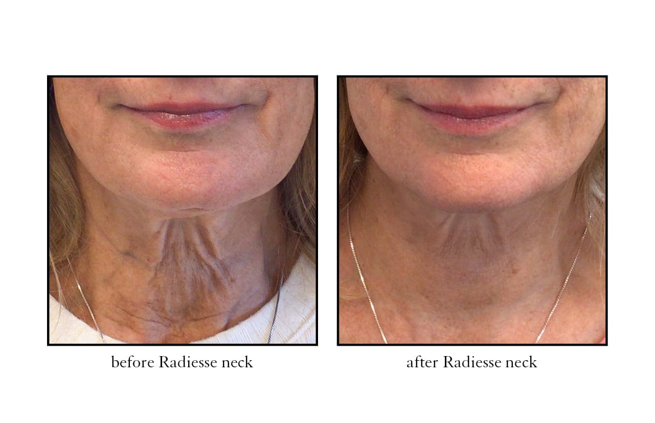radiesse Radiesse Neck