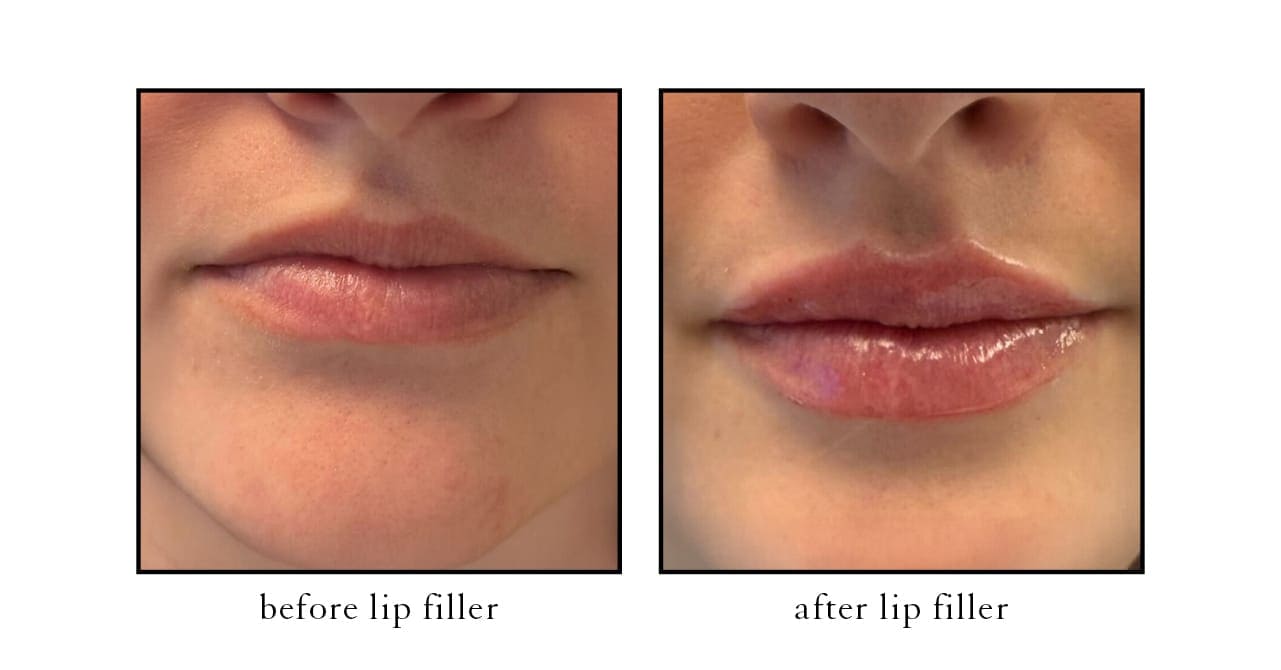 filler lip Actual CSLC Results