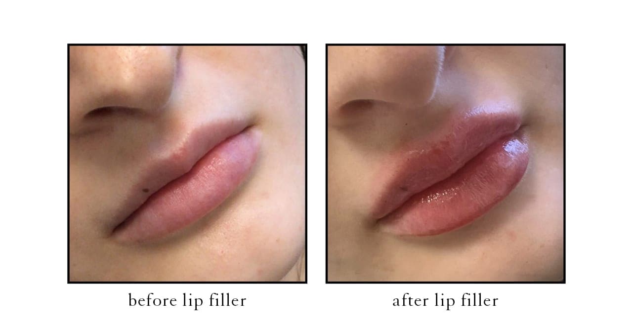 filler lip2 Actual CSLC Results