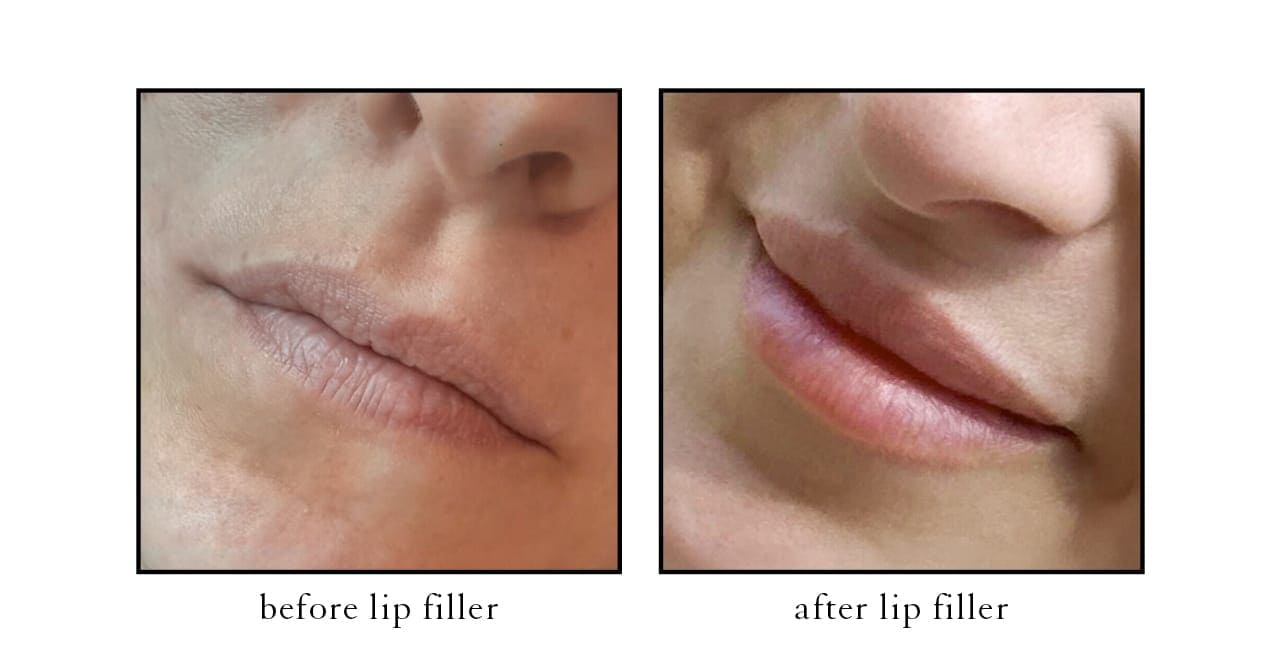 filler lip3 Actual CSLC Results