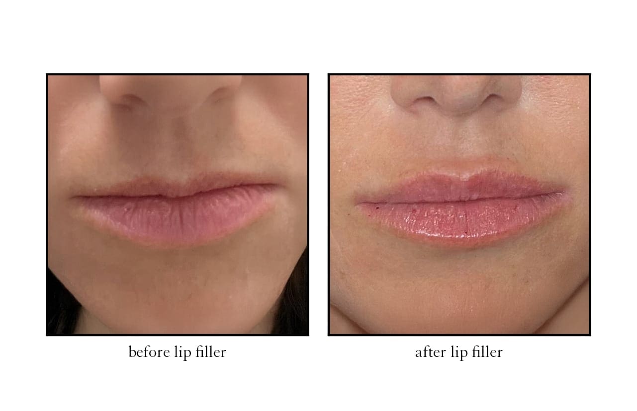 lip_filler2