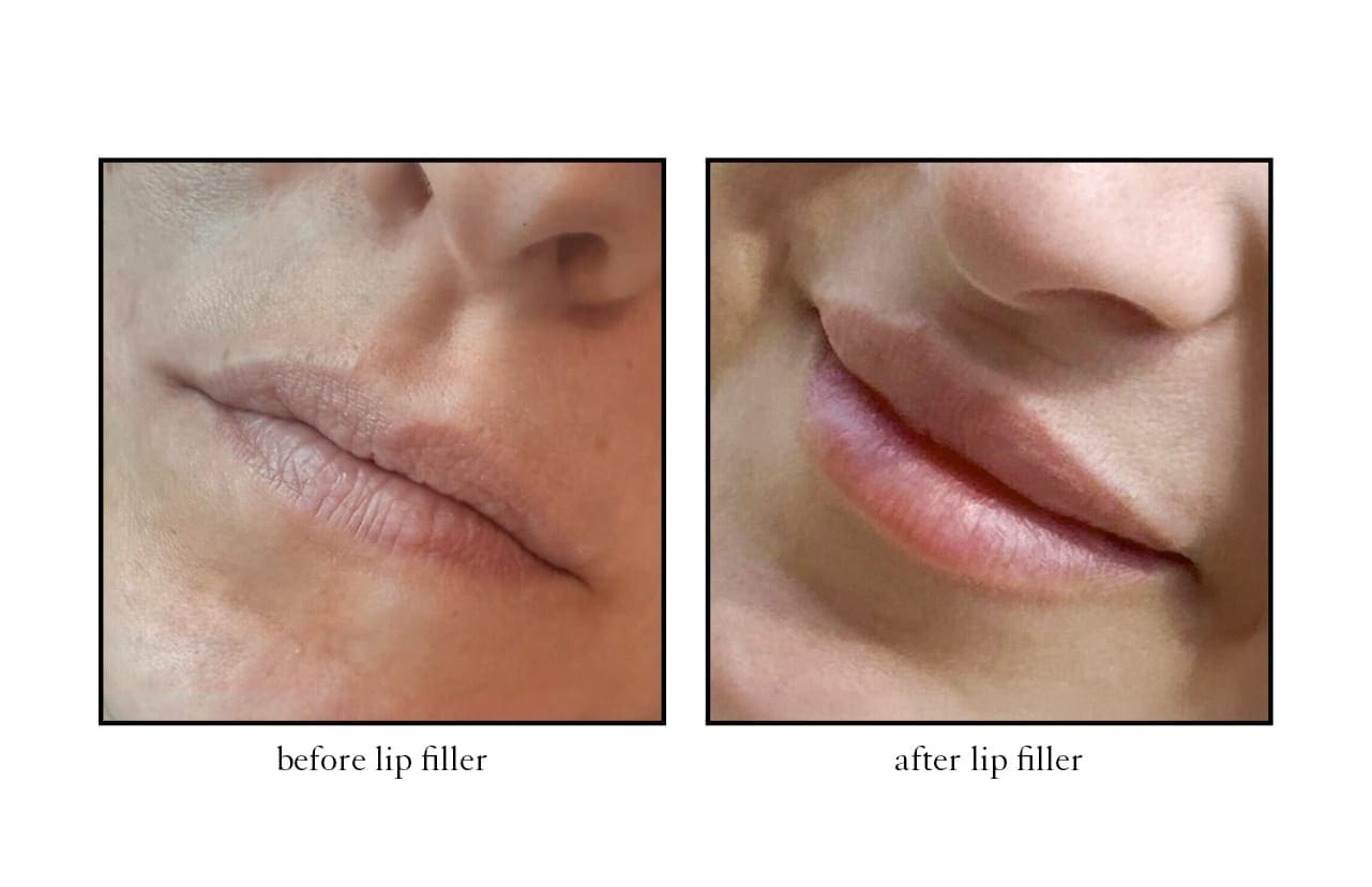 lip_filler4