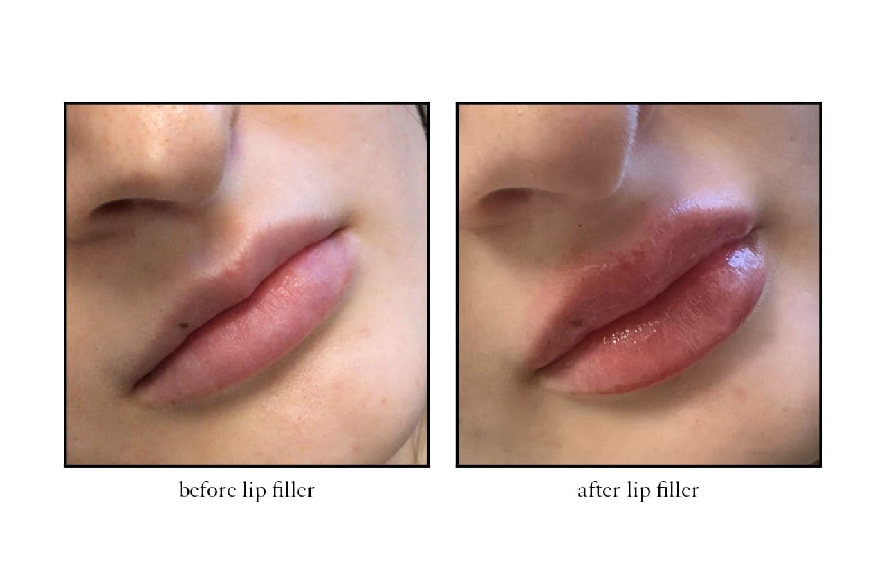 lip_filler5